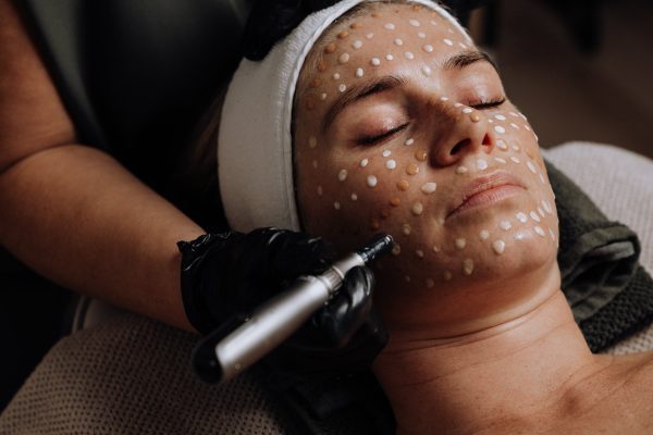 Microneedling